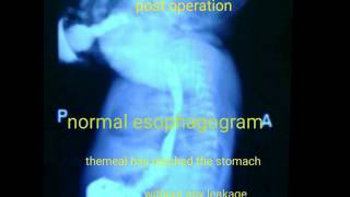 Esophageal atresia [upl. by Ruel]