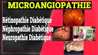 Complications Chroniques du Diabète Microangiopathie Diabétique  Endocrinologie Medicale [upl. by Eillac80]