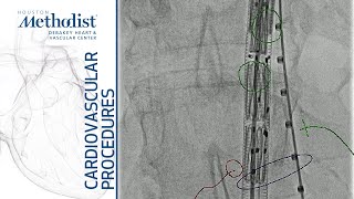 Fenestrated Aortic Graft Placement with Inferior Mesenteric Embolization Lumsden MD Atkins Jr MD [upl. by Read792]