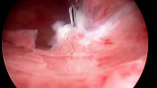 Hysteroscopic Morcellation of Myoma [upl. by Alusru]