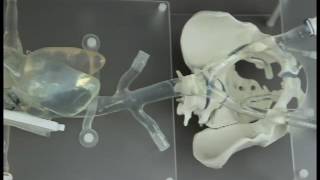 Transseptal model on pelvis sled [upl. by Nomahs]