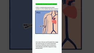 peripherally inserted central catheter medicaleducation catheter nursing [upl. by Elpmet]