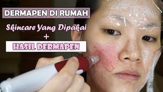 VIDEO LENGKAP CARA MENGHILANGKAN BOPENGACNE SCAR DENGAN DERMAPEN DI RUMAH [upl. by Naitsirhc]