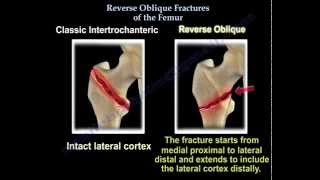 Reverse Oblique Hip Fractures  Everything You Need To Know  Dr Nabil Ebraheim [upl. by Artemisia]