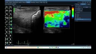 IQ 277 LIVER ELASTOGRAPHY HEPATOMA ECHOPAC ANALYSIS ULTRASOUND [upl. by Codie]