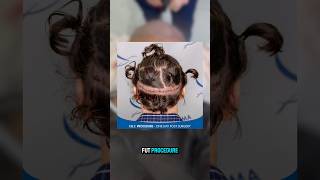 FUE vs FUT scar 4500 grafts FUE process hairtutorial transplant hairtransplant [upl. by Rema]