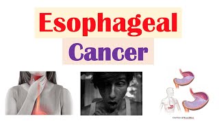 Esophageal Cancer  Risk Factors Pathogenesis Signs and Symptoms Diagnosis Treatment [upl. by Huff]