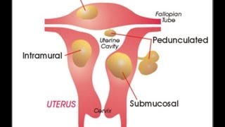 Myoma Uterine Fibroids  What is Myoma Causes Symptoms and Treatment for Myoma [upl. by Eirovi]