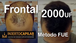 Transplante Capilar x técnica FUE 2000 Uf [upl. by Carl]