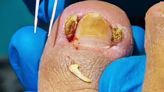 Infected Ingrown Toenail Left Untreated TOO LONG [upl. by Jennica]