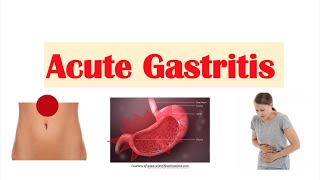 Acute Gastritis Stomach Inflammation  Causes Signs amp Symptoms Diagnosis Treatment [upl. by Ayekat]