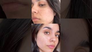 How I Reduced My Pigmentation In 2 weeks😍 [upl. by Ahterod413]