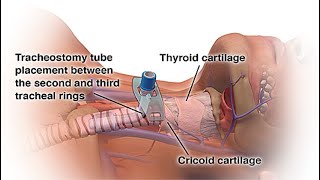 What is a Tracheostomy  A Guide to the Artificial Trachea [upl. by Omura]