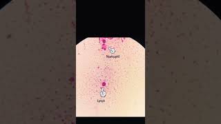 sputum smear [upl. by Diraj]