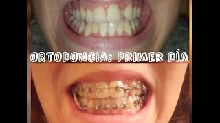 ORTODONCIA Primer día con Brackets ♥  FaviChic [upl. by Haisoj370]