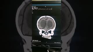 Hydrocephalus  Babay CT  Head anatomy  Findings of Head  Medical Imaging  Brain CT [upl. by Hiroko]