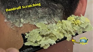 Dry Scalp  Dandruff Scratching 1246 [upl. by Accebar670]