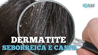 DERMATITE SEBORREICA E CASPA QUAIS SÃO AS CAUSAS E O QUE FAZER [upl. by Zerla714]