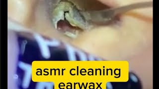 ASMR EARWAX REMOVAL [upl. by Cohe692]