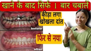 सिर्फ 1 बार चबा लो कीड़ा लगा खोखला दांत फिर से नया Tooth Cavity [upl. by Dennison]