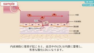 メヂカルフレンド社「新体系看護学全書 病理学」サンプル動画① アテローム硬化 [upl. by Eisele412]