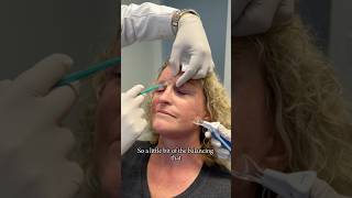 25 months postop selective neurolysis surgery Botox explanation bellspalsy botox facialpalsy [upl. by Goldsmith]