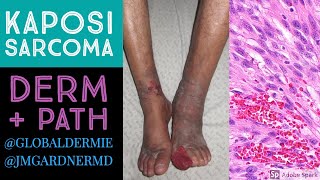 Kaposi Sarcoma DermatologyPathology Collaboration by globaldermie amp JMGardnerMD [upl. by Yrram732]