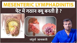 पेट में गठान क्यू बनती है   पेट की सोनोग्राफी में आई हैMesenteric lymphadinitis guthealth [upl. by Aynot260]