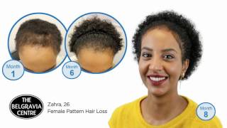 Belgravia Female Hair Loss Treatment Success Story  Ms S Full Video [upl. by Halivah]