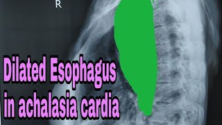 Achalasia cardia x ray finding [upl. by Glialentn392]