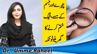 Amazing Way to Remove Skin Tags  Moles  Warts  Dr Umme Raheel [upl. by Alrats]