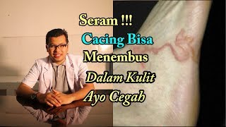 Cacing Masuk Ke Dalam Kulit Cutaneous Larva Migrans CLM [upl. by Thorncombe]