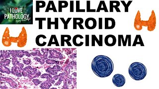 PAPILLARY THYROID CARCINOMA  Gross and Microscopic features [upl. by Catima393]