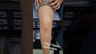 J Sign Patella Dislocation kneepain patelladislocation patella arthroscopicsurgery [upl. by Trainor341]