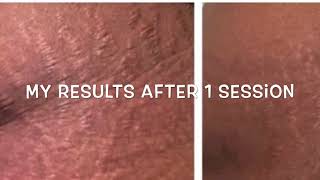 Microneedling Stretch Marks Treatment Before and After [upl. by Engapmahc149]