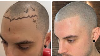 Scalp Micropigmentation HiDef Real Results [upl. by Cly641]