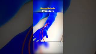 Hemodialysis procedure cardiacnurse medicalprofessional 100view doctor [upl. by Gaillard]