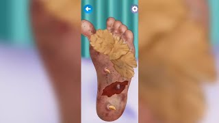 Satisfying Foot Warts Treatment  ASMR Treatment  Deep Cleaning Animation asmr asmrvideo [upl. by Gilboa]