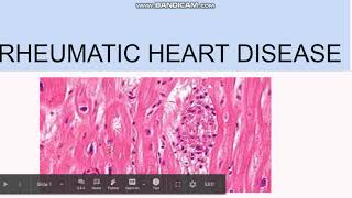 Rheumatic Heart Disease Pathogenesis Morphology Clinical features [upl. by Jd]