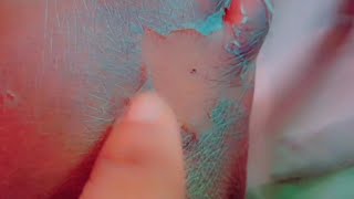 My Skin Peeling Satisfying Video [upl. by Suivatra]