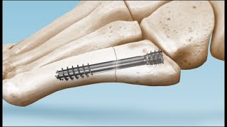 Fifth Metatarsal Fracture fracture podiatrylife footdoctor [upl. by Proctor]