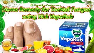 Home Remedy for Toe Nail Fungus using VikVaporub [upl. by Markland659]