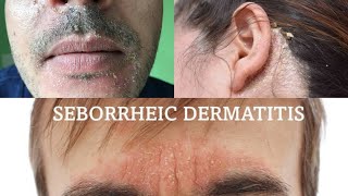 Seborrheic dermatitis  treatment health [upl. by Dolan929]