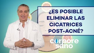 ¿Es posible eliminar las cicatrices postacné [upl. by Eus]