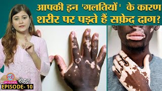 शरीर पर सफ़ेद दाग पड़ने वाली बीमारी Vitiligo क्या ठीक हो सकती है Sehat Ep 10 [upl. by Icyak341]