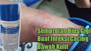 Obat Semprotan Gigi ini Bisa Juga Untuk Infeksi Parasit Cacing Bawah Kulit  Cutaneous Larva Migrans [upl. by Oilut874]