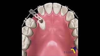 Canine Impaction dentistbracing orthodonticscanineimpactionImpactionExposureCanineexposure [upl. by Kehr]