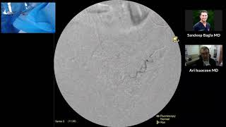 PAE Live Radial Prostatic Artery Embolization with Dr Bagla [upl. by Benis]