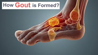 How Gout is Formed [upl. by Carny]