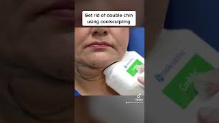 Doublechin removal using coolsculpting shorts [upl. by Nicolea279]